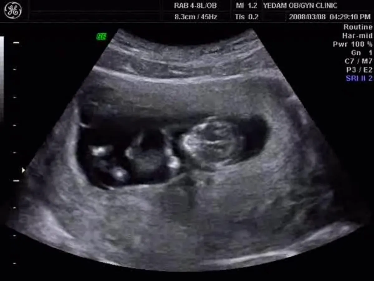 2D, 3D, 4D czyli nowoczesna ultrasonografia w ginekologii i położnictwie