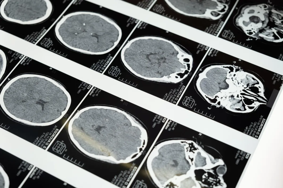 22 lipca Światowy Dzień Mózgu; w Polsce jest około 5 mln osób chorych na choroby neurologiczne