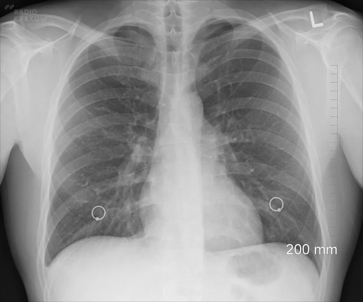 Bezpłatne badana tomograficzne płuc dla mieszkańców powiatu myślenickiego