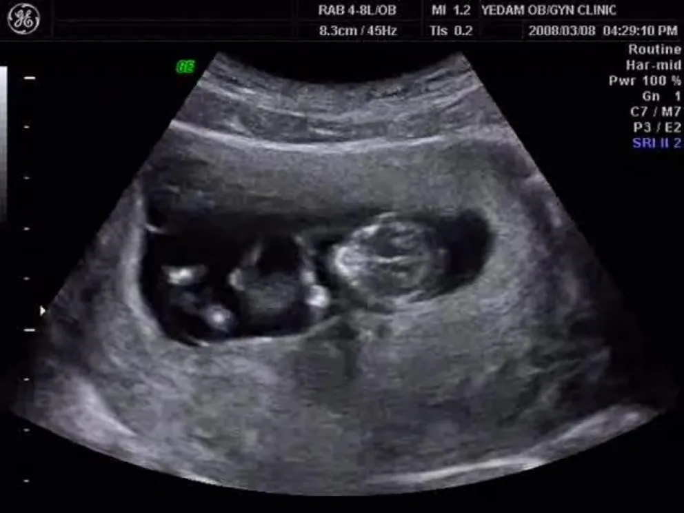 2D, 3D, 4D czyli nowoczesna ultrasonografia w ginekologii i położnictwie